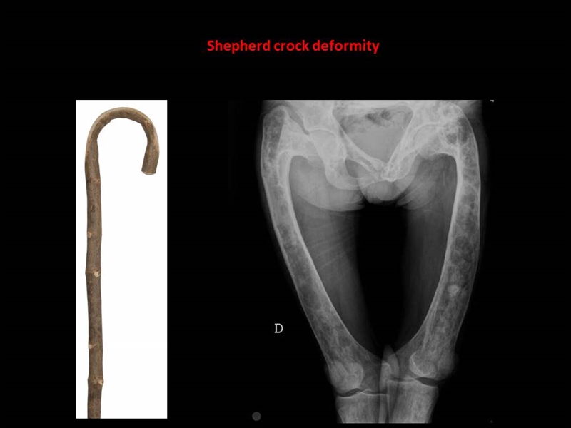 LOẠN SẢN XƠ XƯƠNG (fibrous dysplasia)